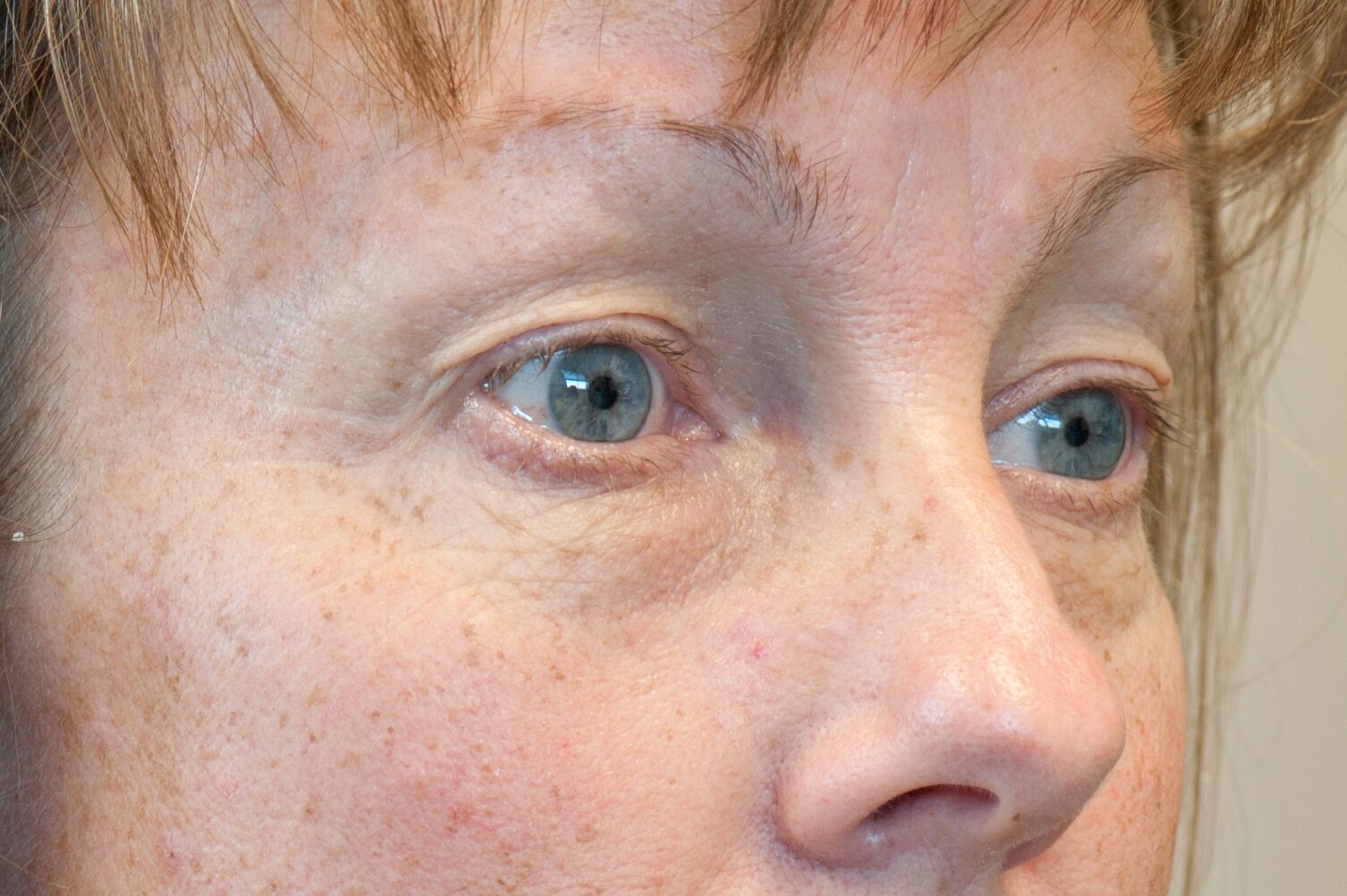 after-eyes-exilis-elite-doctor-nyla