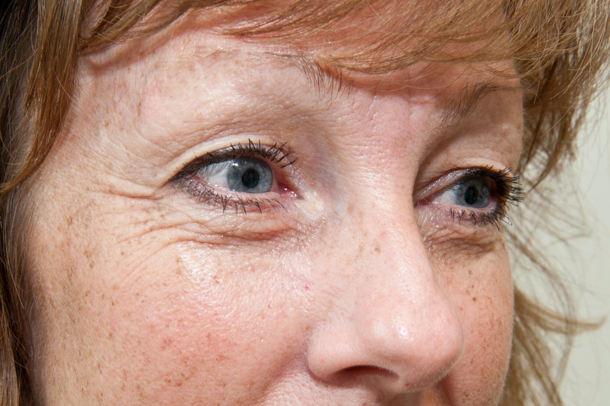 before-eyes-exilis-elite-doctor-nyla