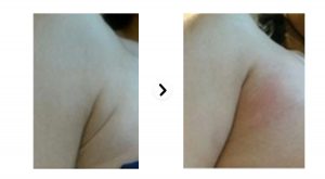 female-arm-before-and-after-Ultraformer-3-Skin-Tightening