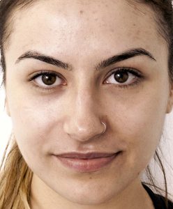Young woman face after receiving carbon peel treatment