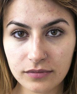 Young woman face before receiving carbon peel treatment