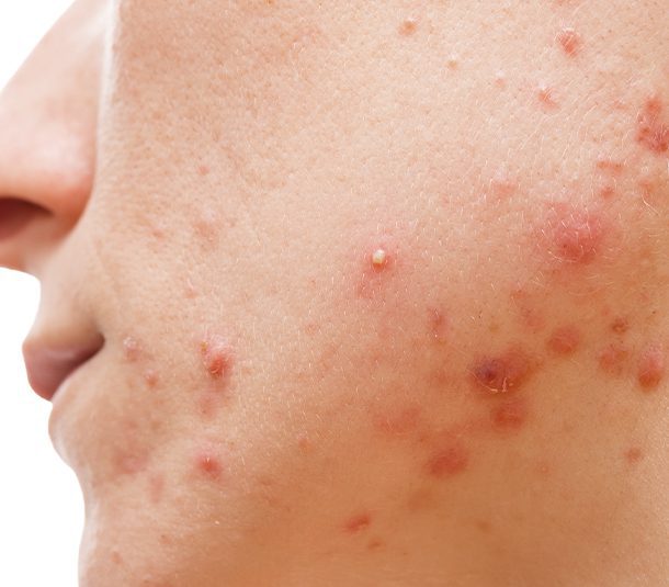 Acne Spots