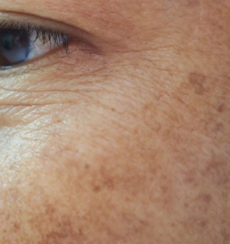 Best Treatment For Age Spots Cheshire