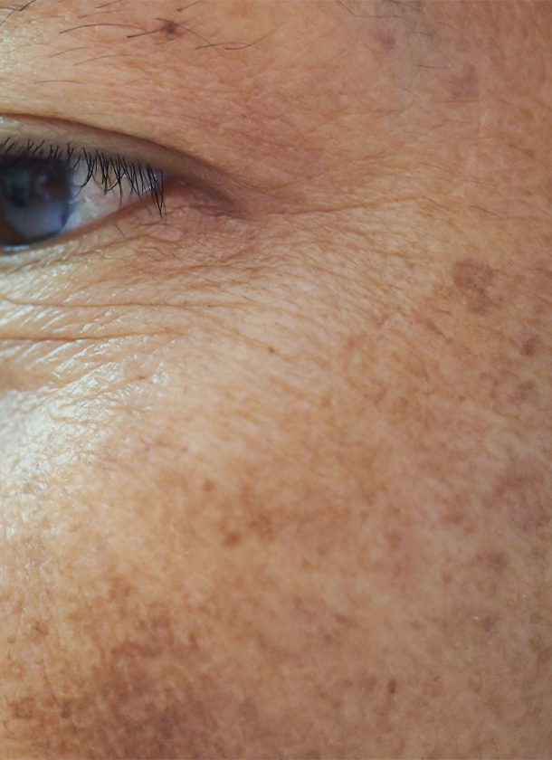 Best Treatment For Age Spots Cheshire