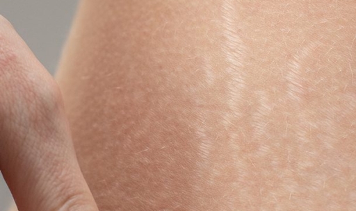 Stretch Marks