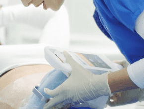 a woman during coolsculpting treatment