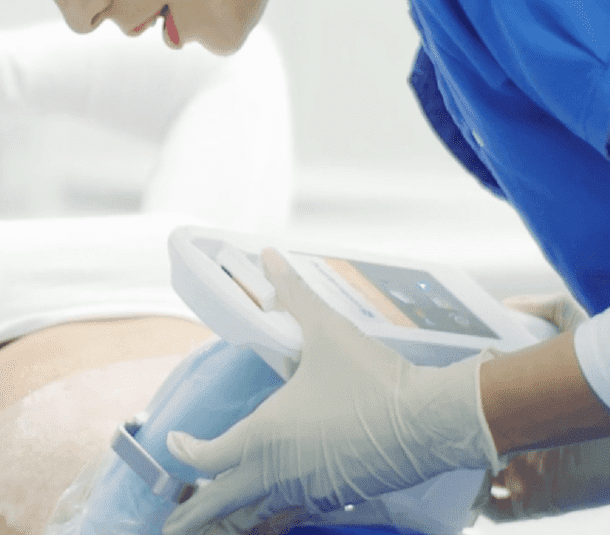 a woman during coolsculpting treatment