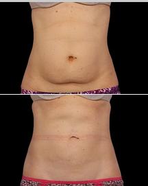 coolsculpting-before and after