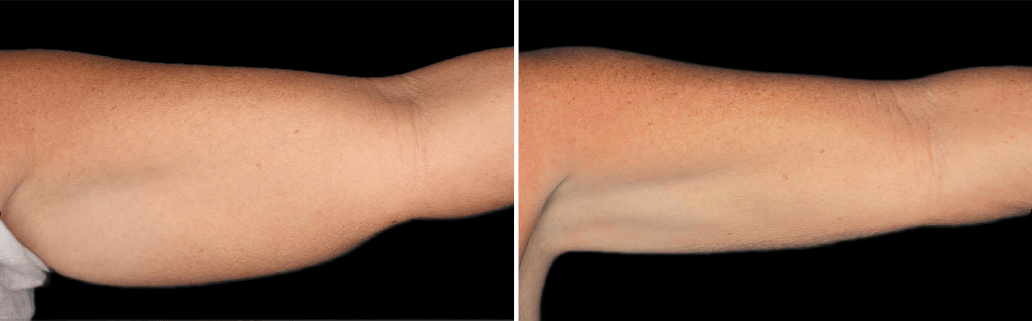 coolsculpting-arms-before-after-dr-nyla