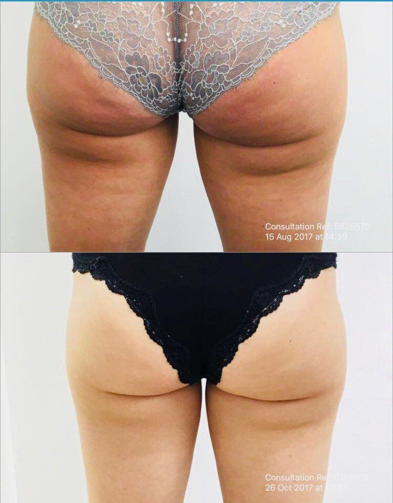 coolsculpting-buttocks-aesthetic-treatment-before-after-doctor-nyla
