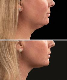 coolsculpting-before-and-after-chin