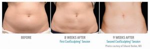 coolsculpting-effects-results-dr-nyla