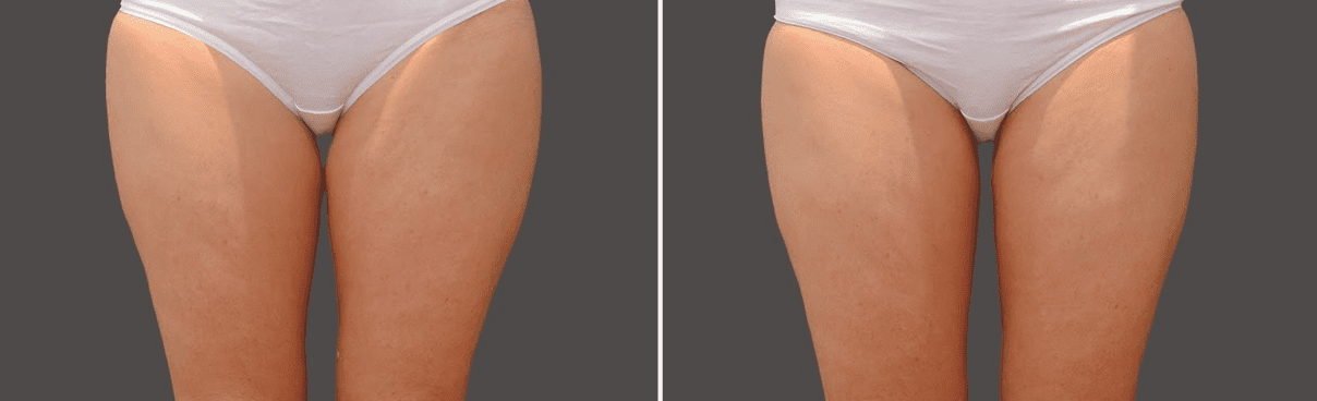 coolsculpting-legs-before-after-dr-nyla