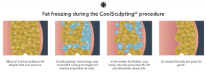 coolsculpting-process-dr-nyla-treatment