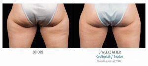 coolsculpting-results-butt-dr-nyla