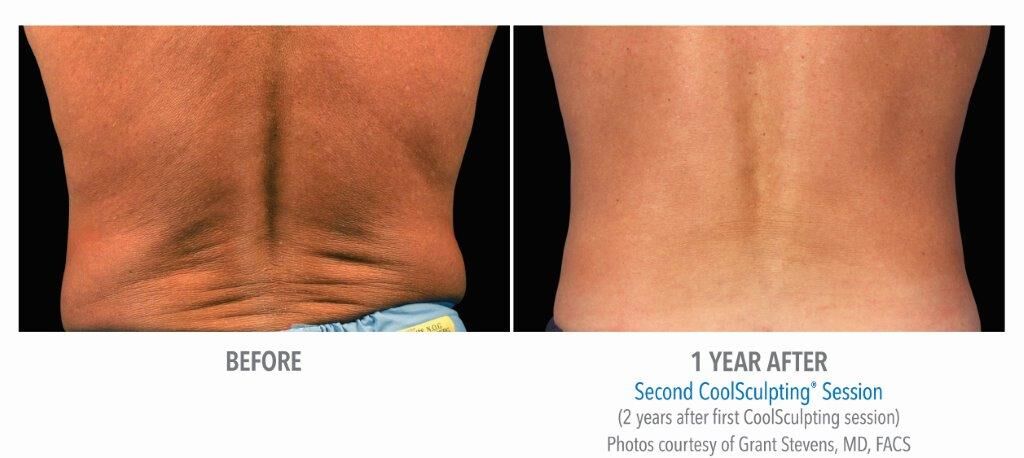 coolsculpting-results-continuous-back