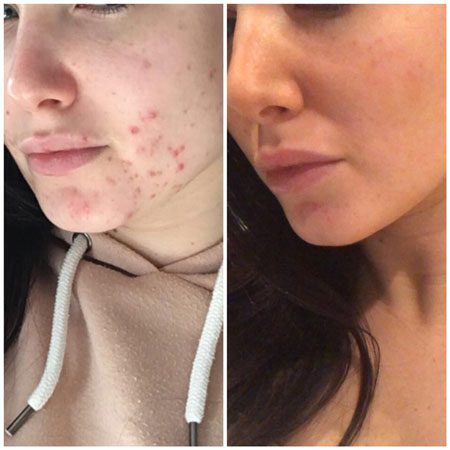 Woman's face before and after ENVY treatment
