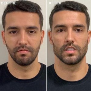 how jawline fillers can help