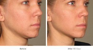 ultracel-cheek-before-after-doctor-nyla