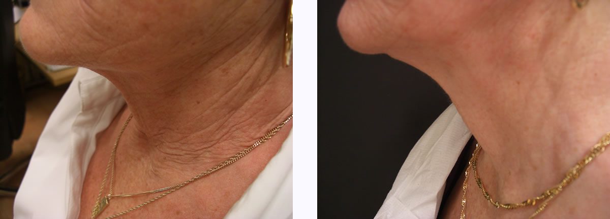 ultracel-treatment-doctor-nyla-skin