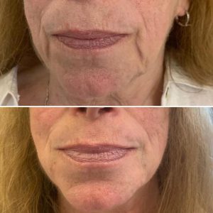 Jowls before and after Ultraformer treatment