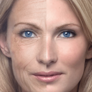 before and after ultrapulse - laser skin resurfacing