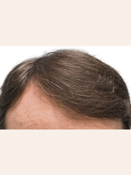Artas-Hair-a4