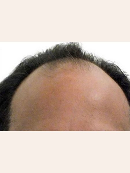 before Artas hair transplant