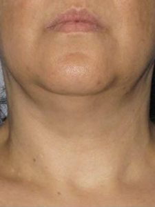 CoolSculpting-a2-chin