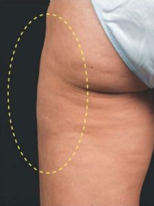 CoolSculpting-a6-thigh