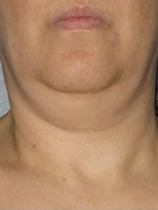 CoolSculpting-b2-chin