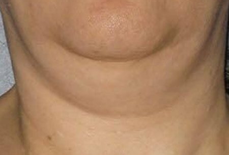 CoolSculpting-b2-chin