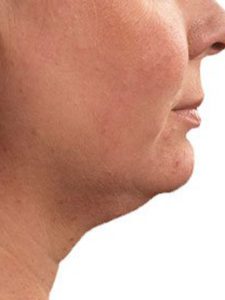 CoolSculpting-b4-chin