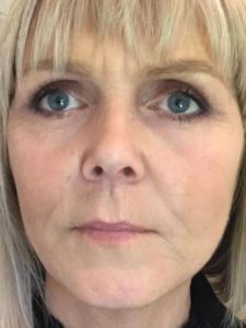 Transformational Facelift after 3