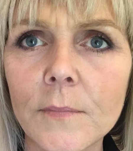 Transformational Facelift after 3