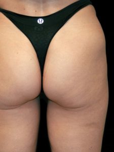 after Unison Cellulite