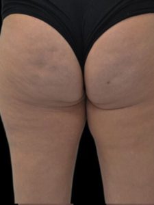 after Unison Cellulite Treatment 6