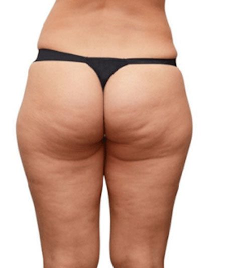 before Unison Cellulite Treatment