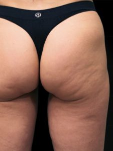 before Unison Cellulite