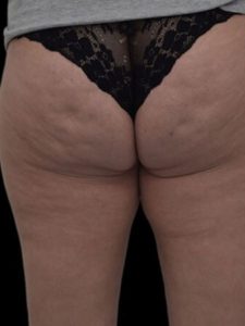 Unison Cellulite Treatment before 6