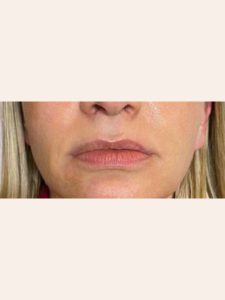 dermal fillers after nasolabial 3