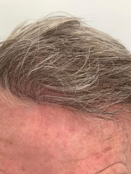 after picture hair transplant