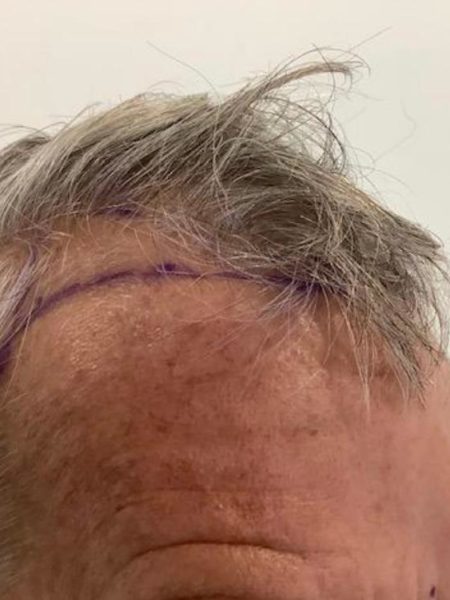 before picture hair transplant