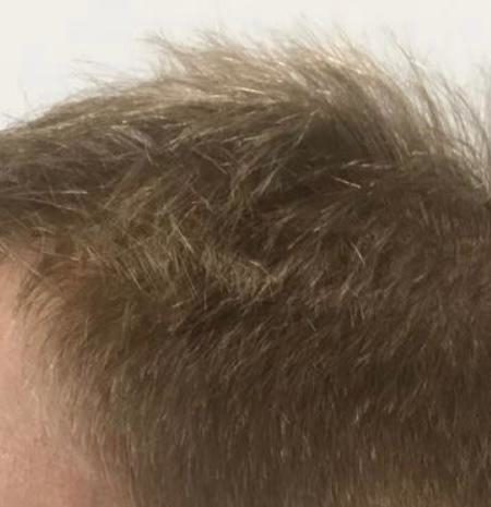 after FUE on hair 
