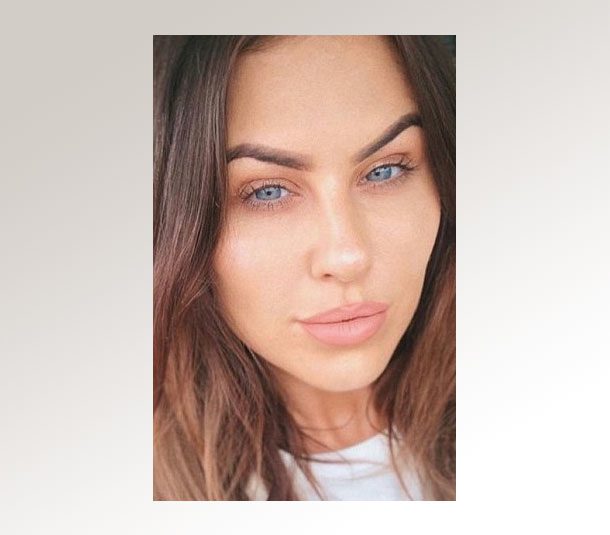 What *not* to do after lip fillers