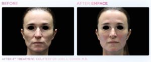 emface before after