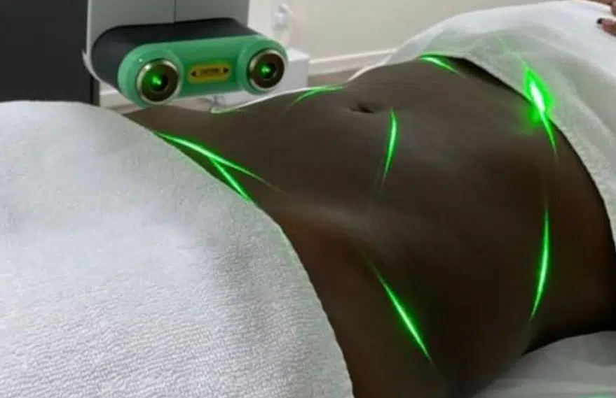 Emerald Laser Treatment