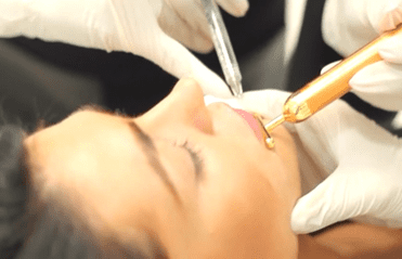 Pateint having dermal fillers