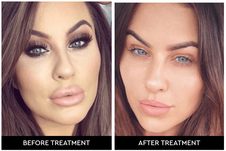 Dissolving Lip Fillers London Doctor Nyla Medispa