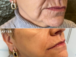 Sagging jowls before and after